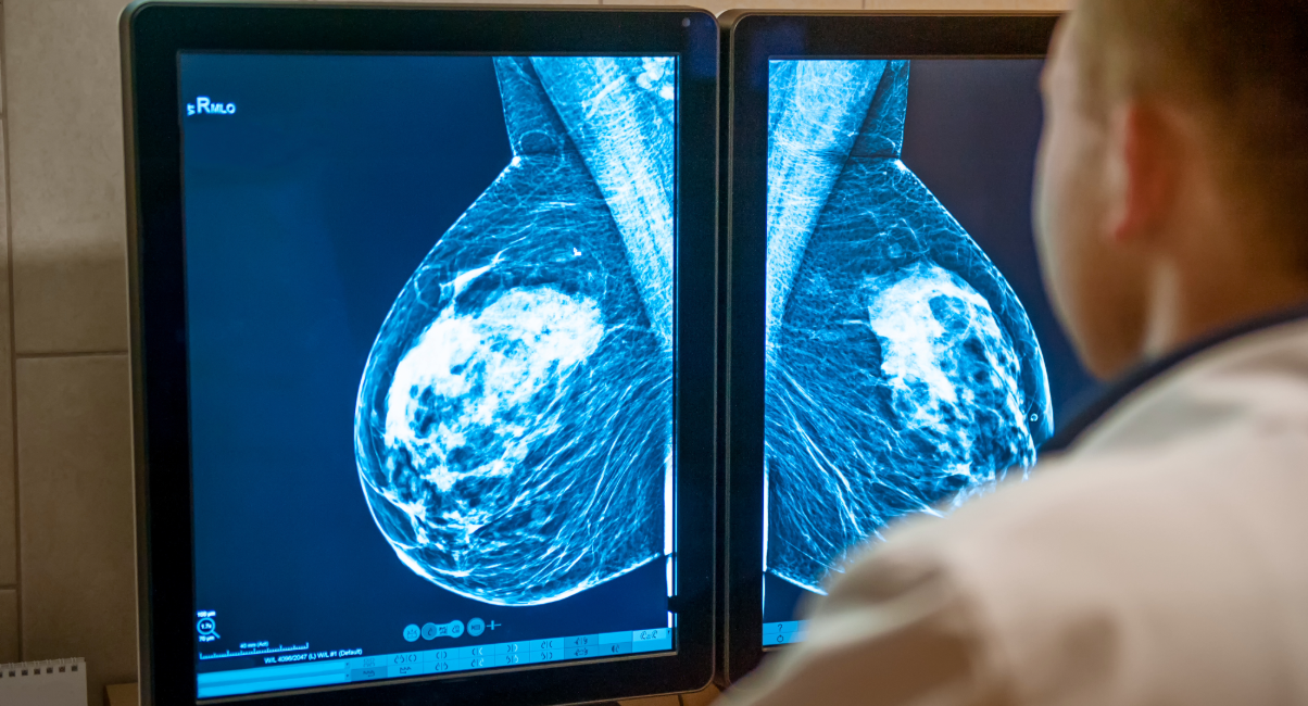How data changed our understanding and care of breast cancer